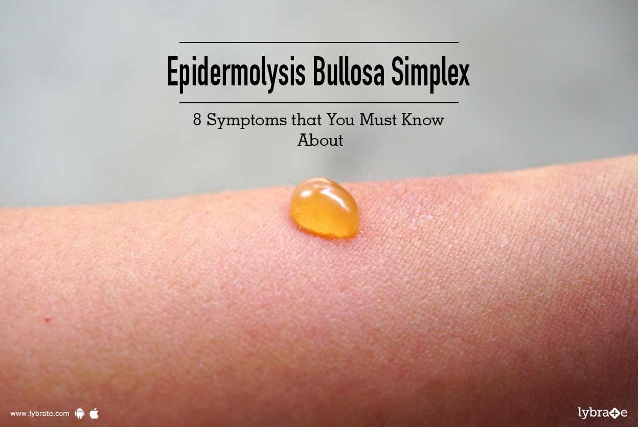 Epidermolysis Bullosa Simplex - 8 Symptoms that You Must Know About