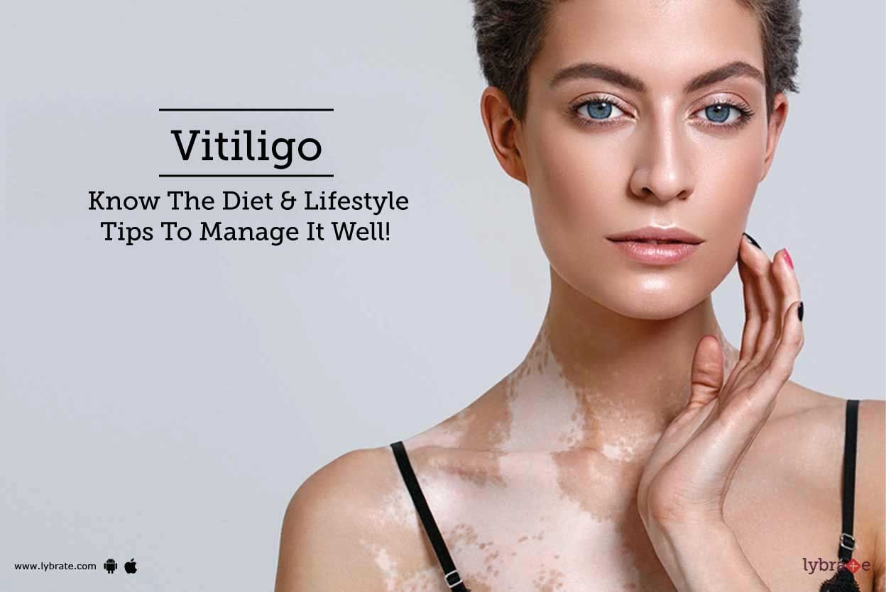 Vitiligo - Know The Diet & Lifestyle Tips To Manage It Well!