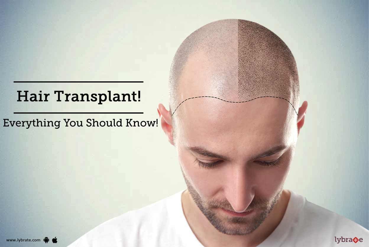 Hair Transplant - Everything You Should Know!