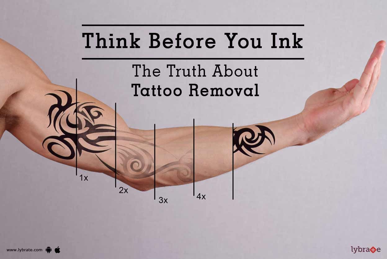 Think Before You Ink: The Truth About Tattoo Removal