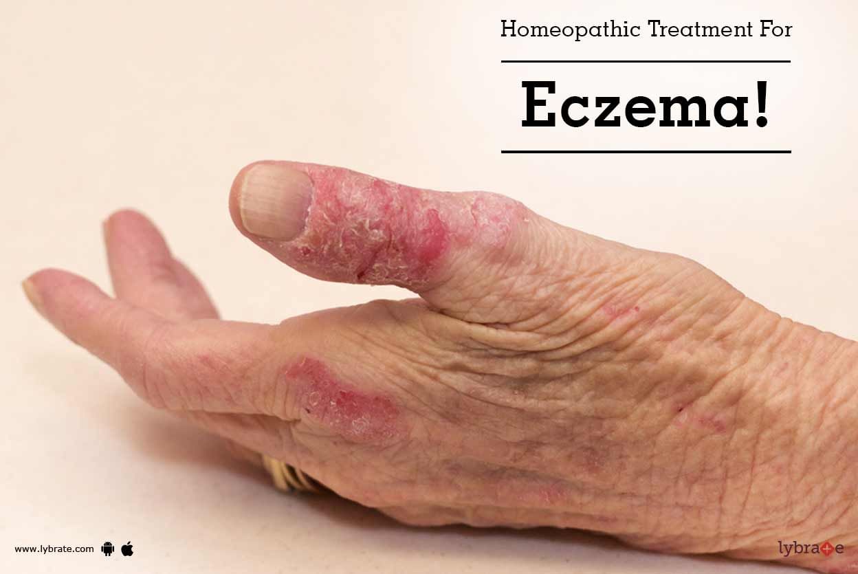 Homeopathic Treatment For Eczema!
