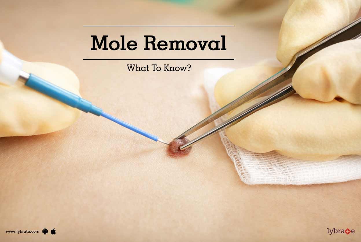 Mole Removal - What To Know?