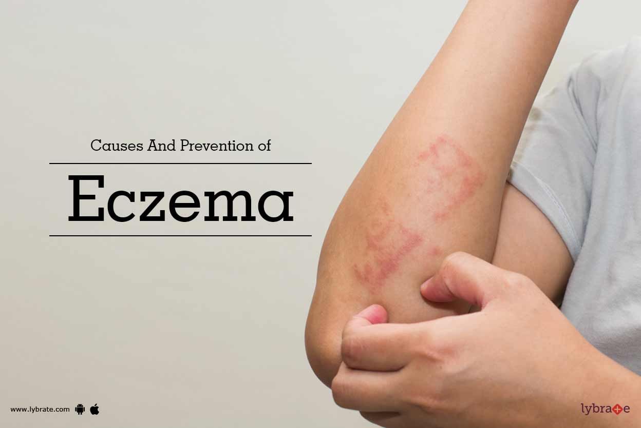 Causes And Prevention of Eczema