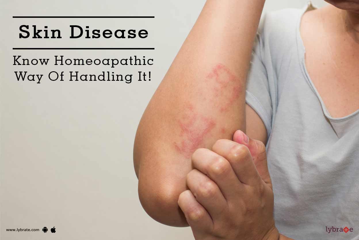 Skin Disease - Know Homeoapathic Way Of Handling It!