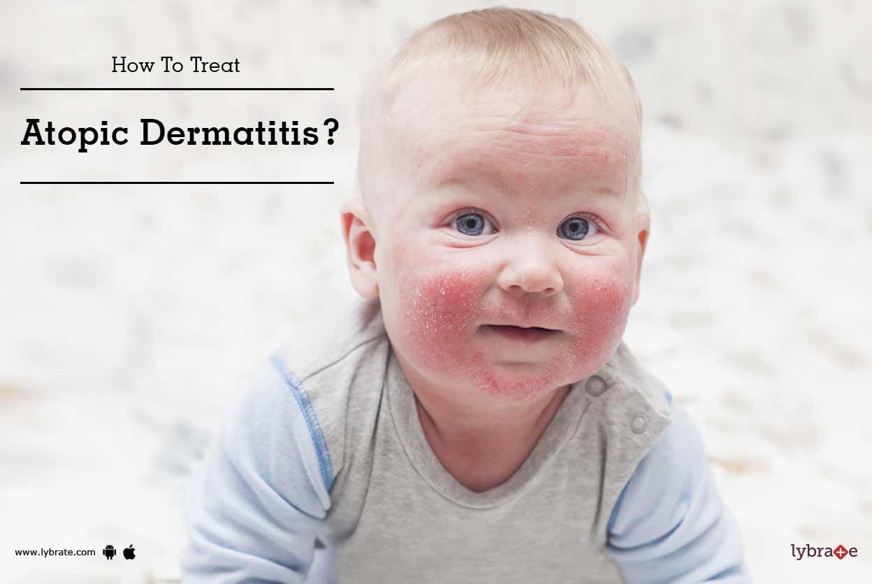 How To Treat Atopic Dermatitis?