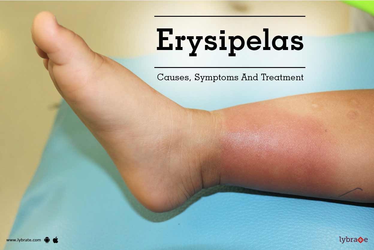 Erysipelas - Causes, Symptoms And Treatment