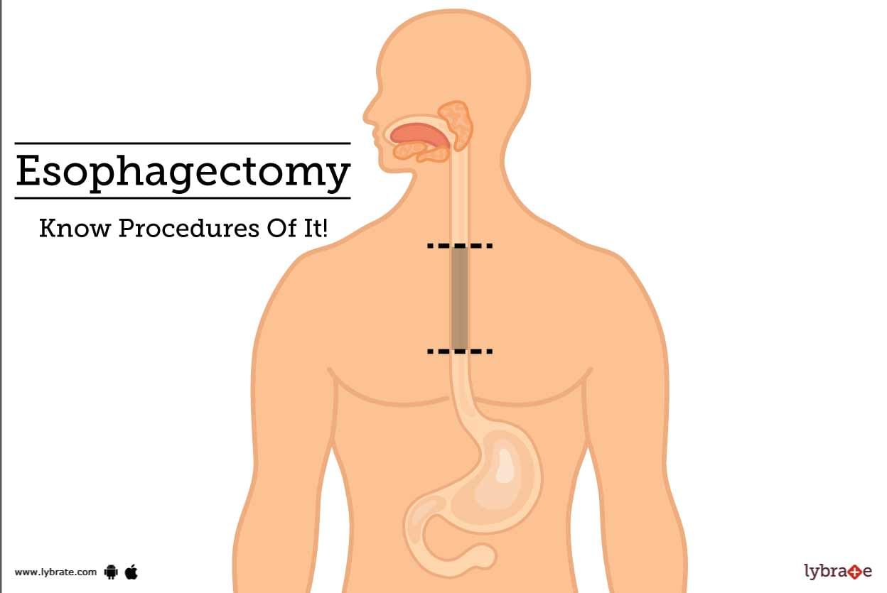 Esophagectomy - Know Procedures Of It!