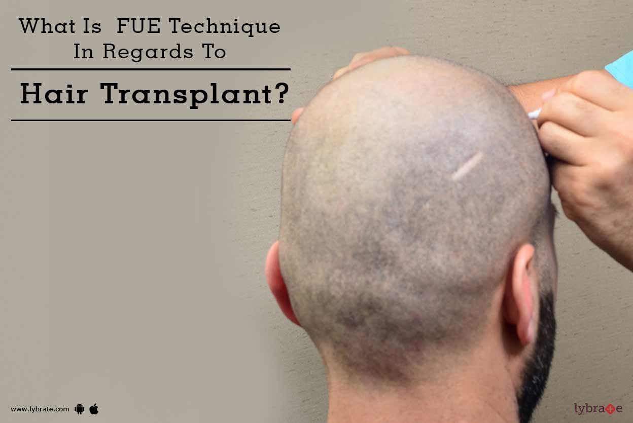What Is  FUE Technique In Regards To Hair Transplant?