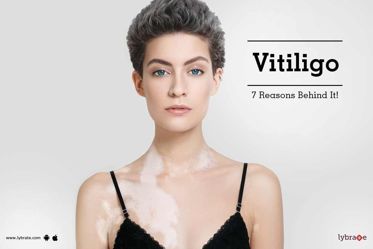 Vitiligo - 7 Reasons Behind It!