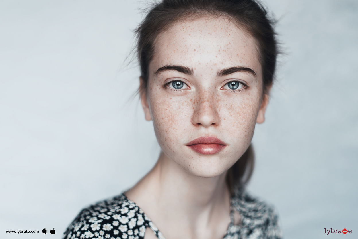 Know The Causes And Treatment Of Freckles!