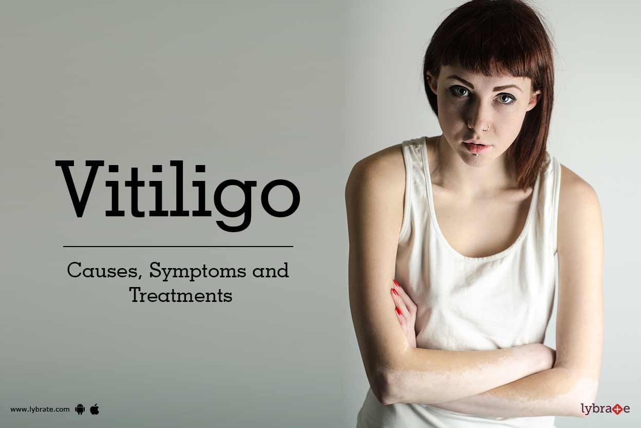 Vitiligo: Causes, Symptoms and Treatments