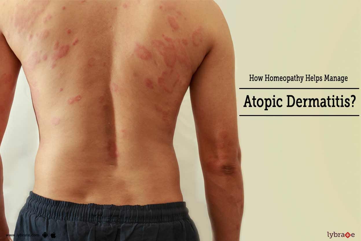 How Homeopathy Helps Manage Atopic Dermatitis?