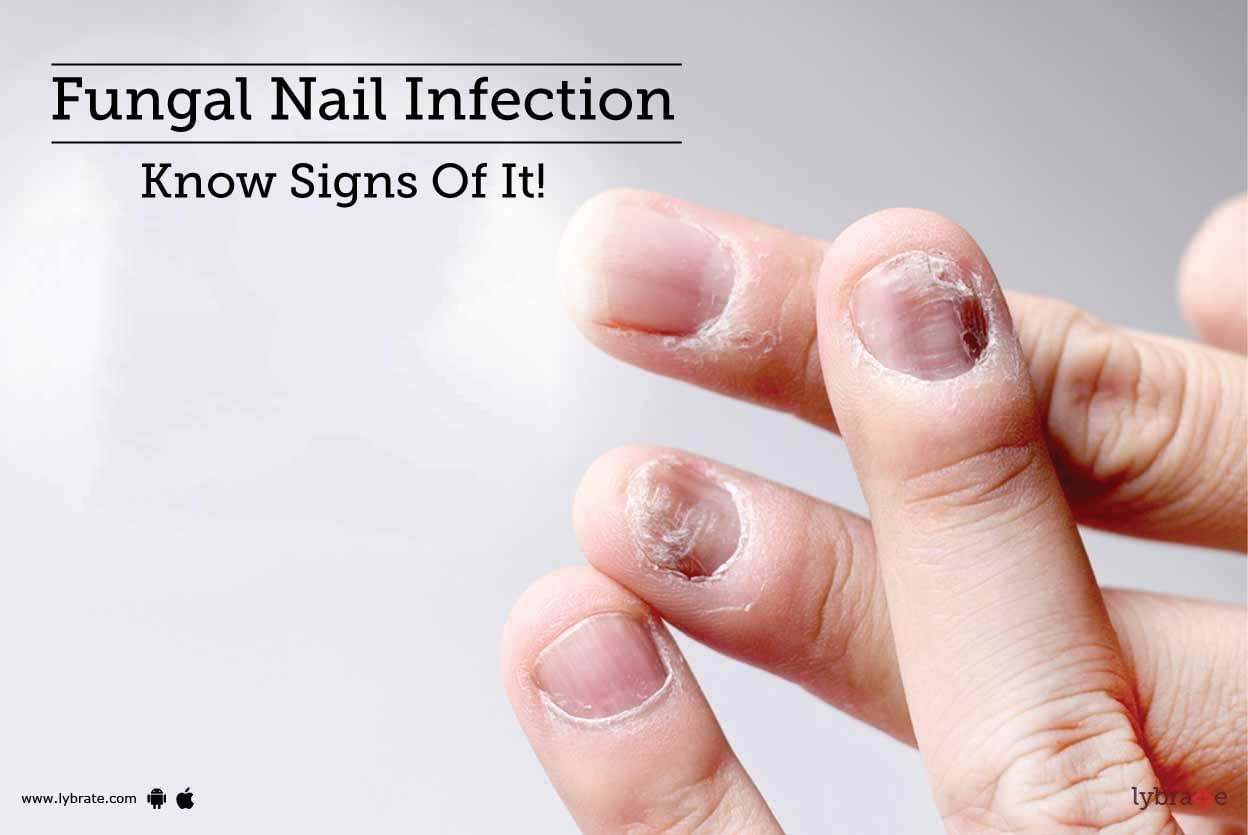 Fungal Nail Infection - Know Signs Of It!