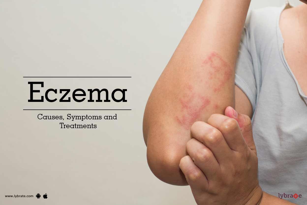 Eczema - Causes, Symptoms and Treatments