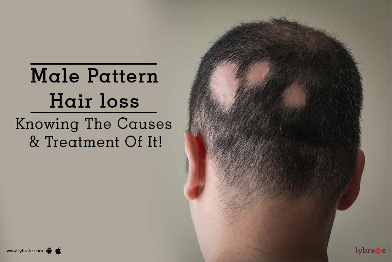 Male Pattern Hair loss - Knowing The Causes & Treatment Of It!