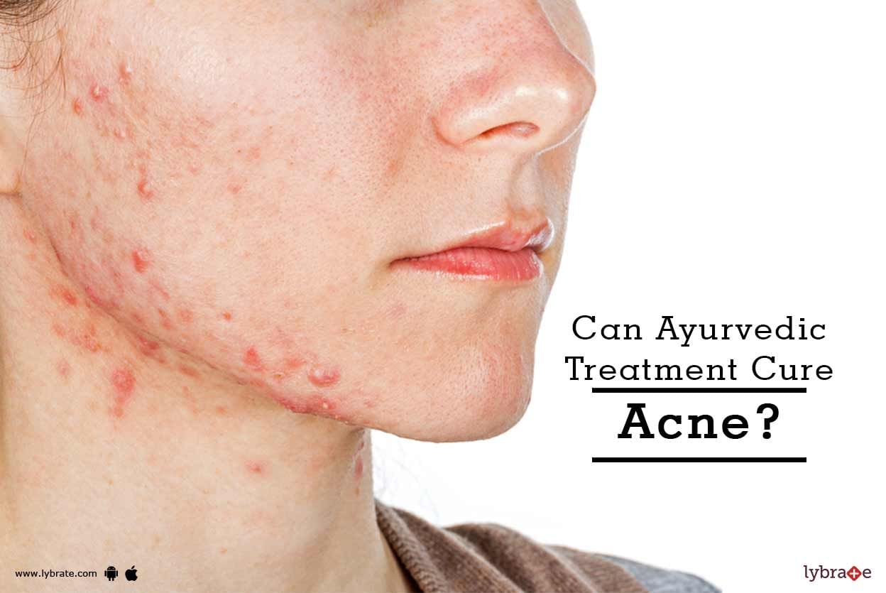 Can Ayurvedic Treatment Cure Acne?