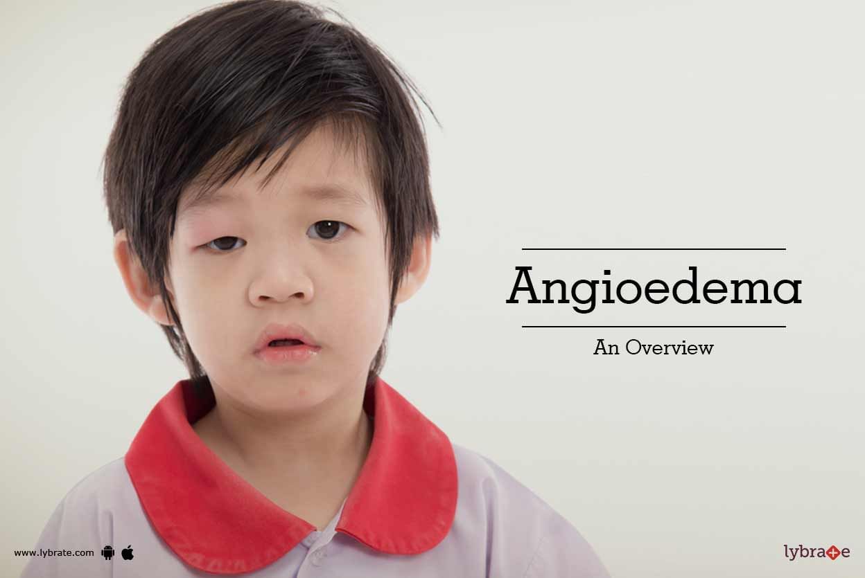 Angioedema - An Overview