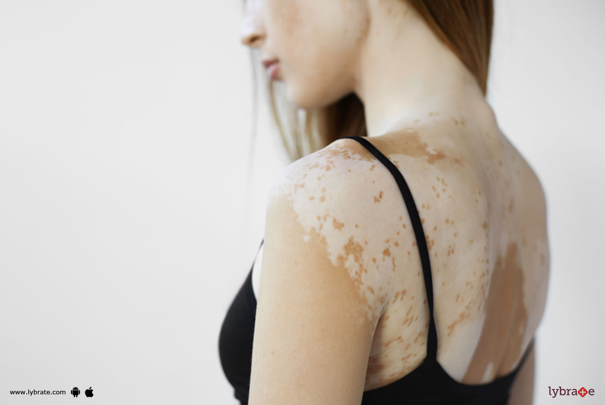 Vitiligo - How Can Homeopathy Resolve It?