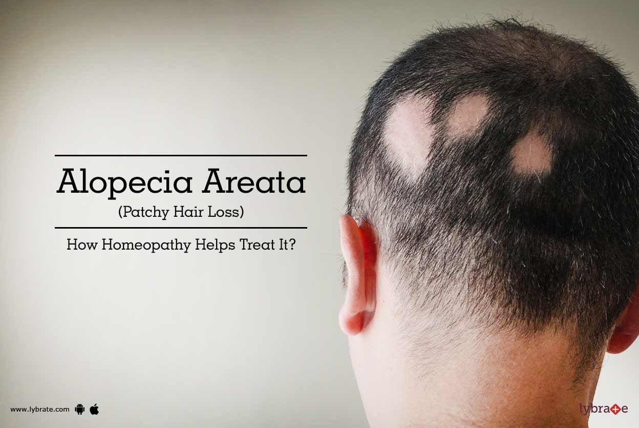 Alopecia Areata(Patchy Hair Loss) - How Homeopathy Helps Treat It?