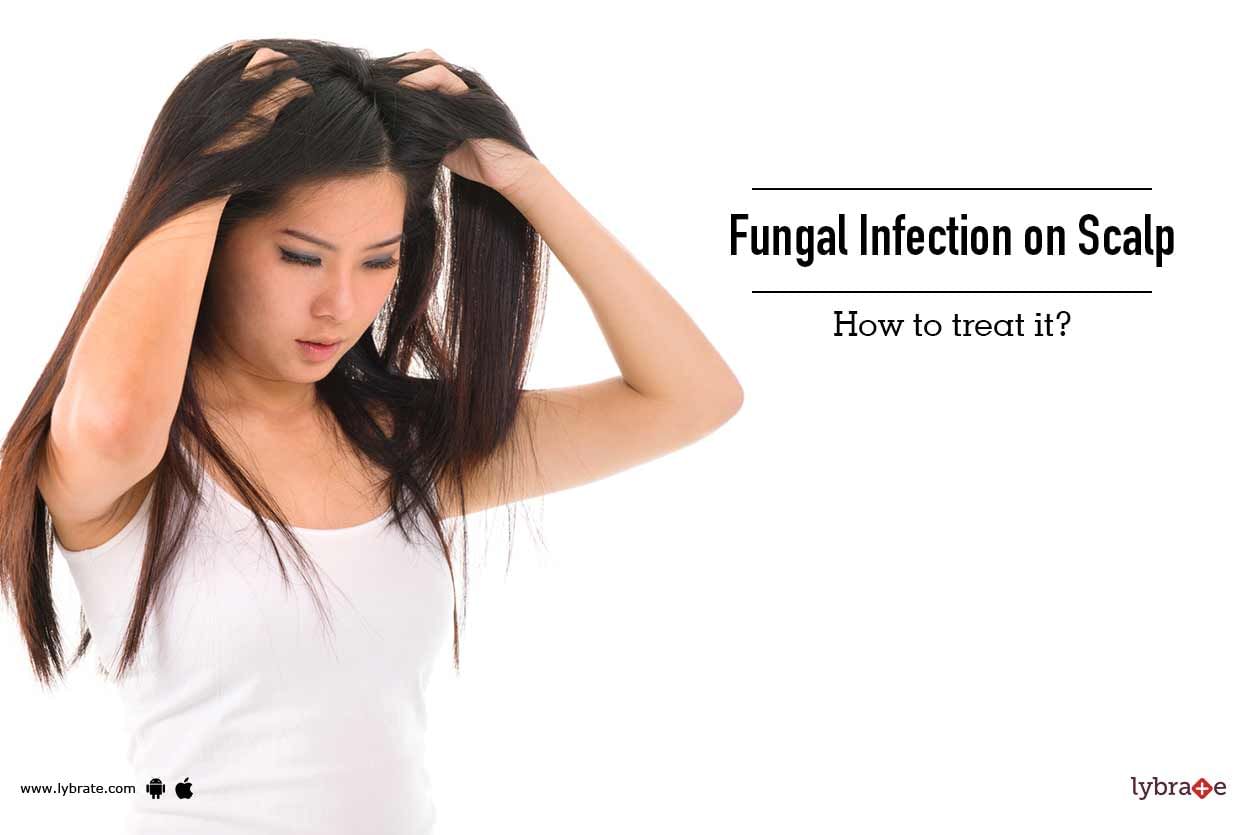 Fungal Infection on Scalp: How to Treat It?