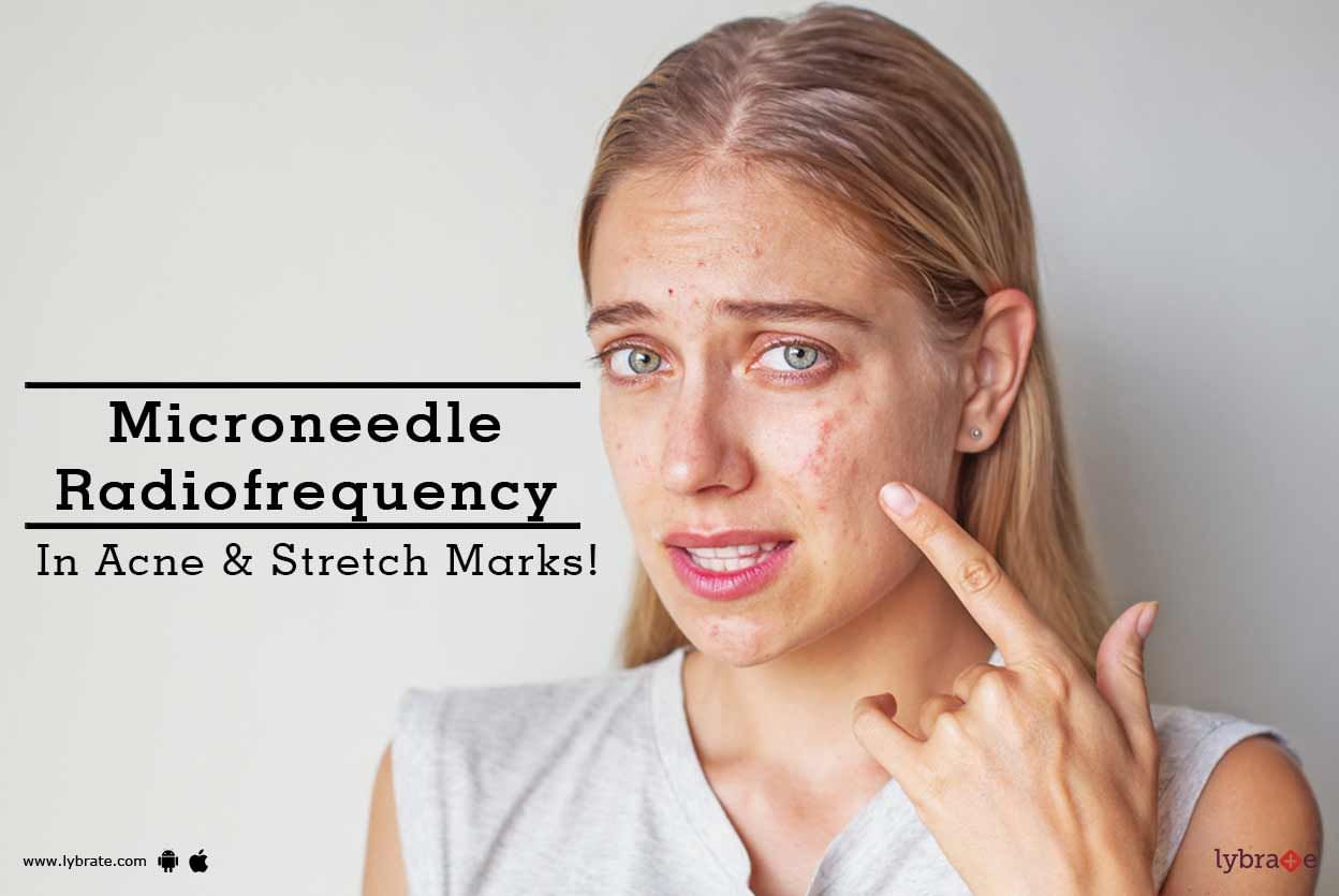 Microneedle Radiofrequency In Acne & Stretch Marks!