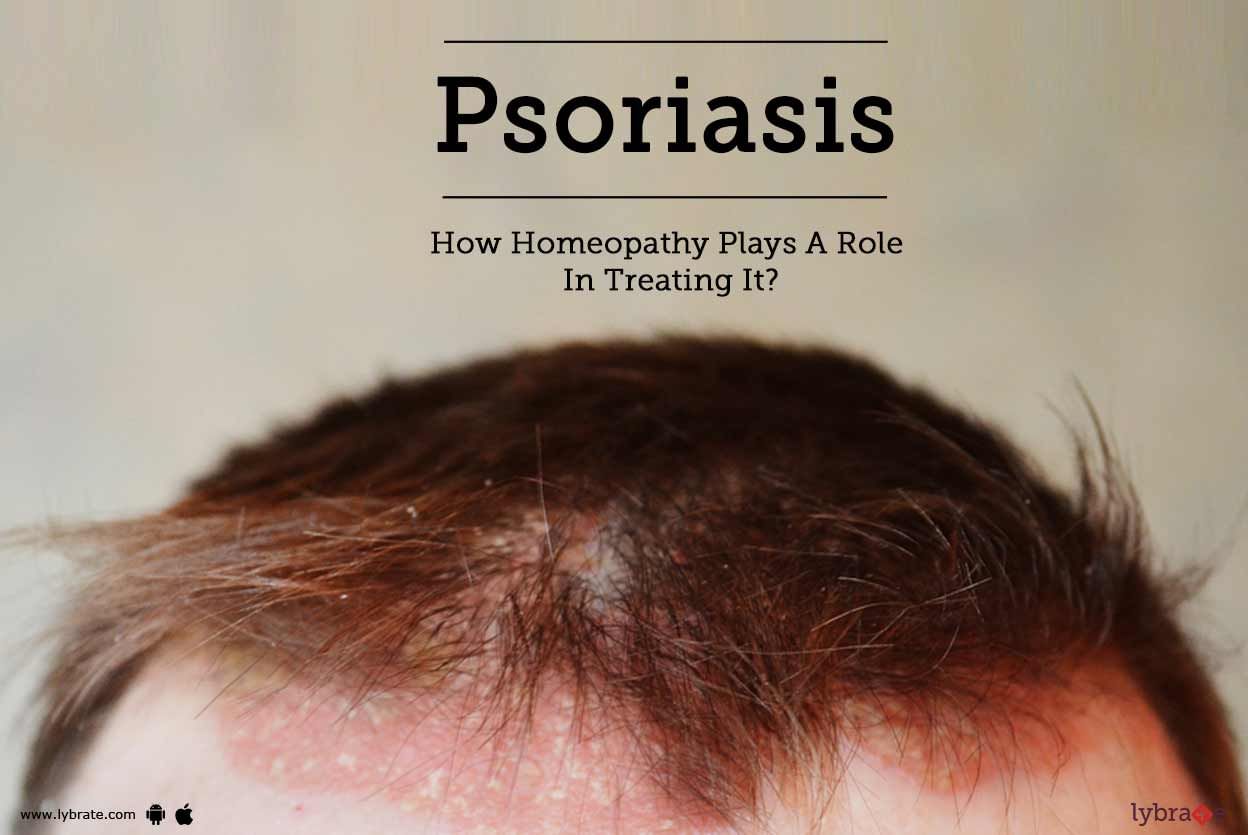 Psoriasis - How Homeopathy Plays A Role In Treating It?