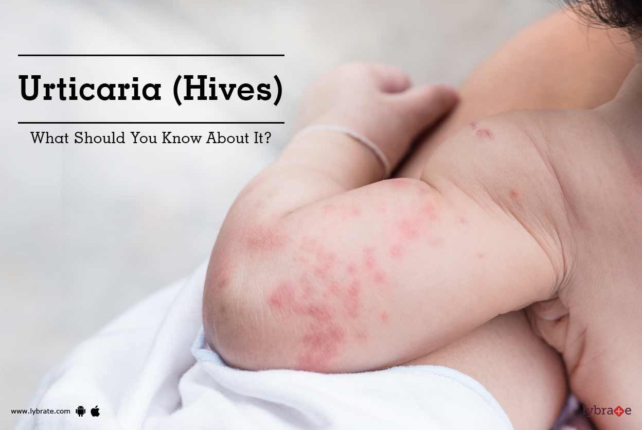Urticaria (Hives):  What Should You Know About It?