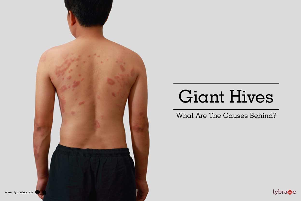 Giant Hives: What Are The Causes Behind?