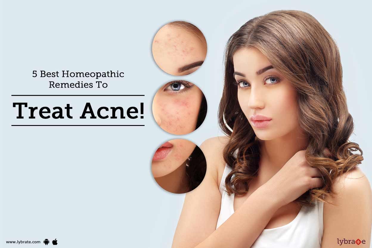 5 Best Homeopathic Remedies To Treat Acne!