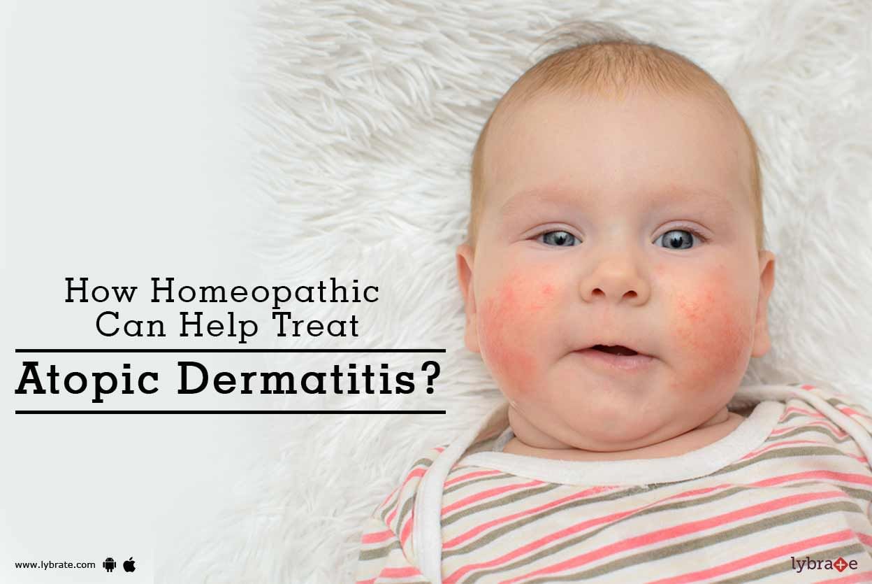How Homeopathic Can Help Treat Atopic Dermatitis?