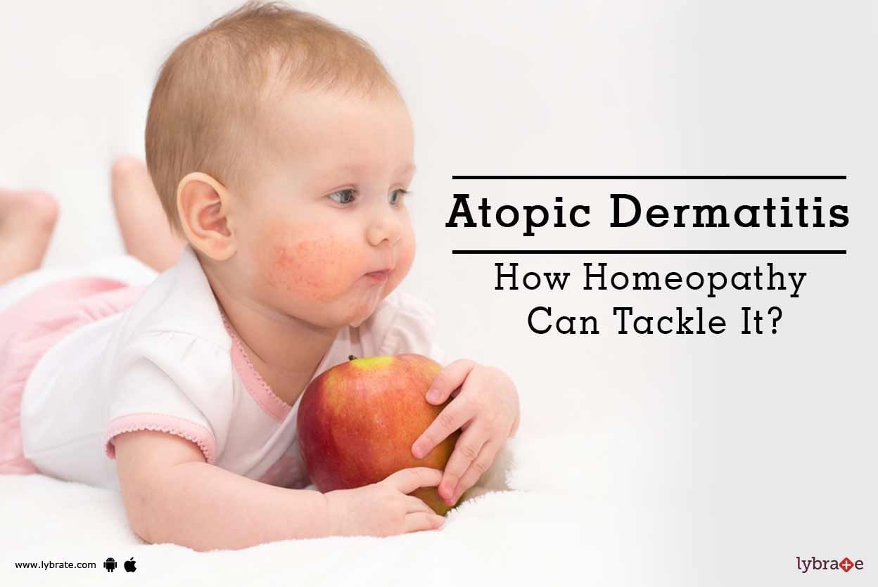 Atopic Dermatitis - How Homeopathy Can Tackle It?