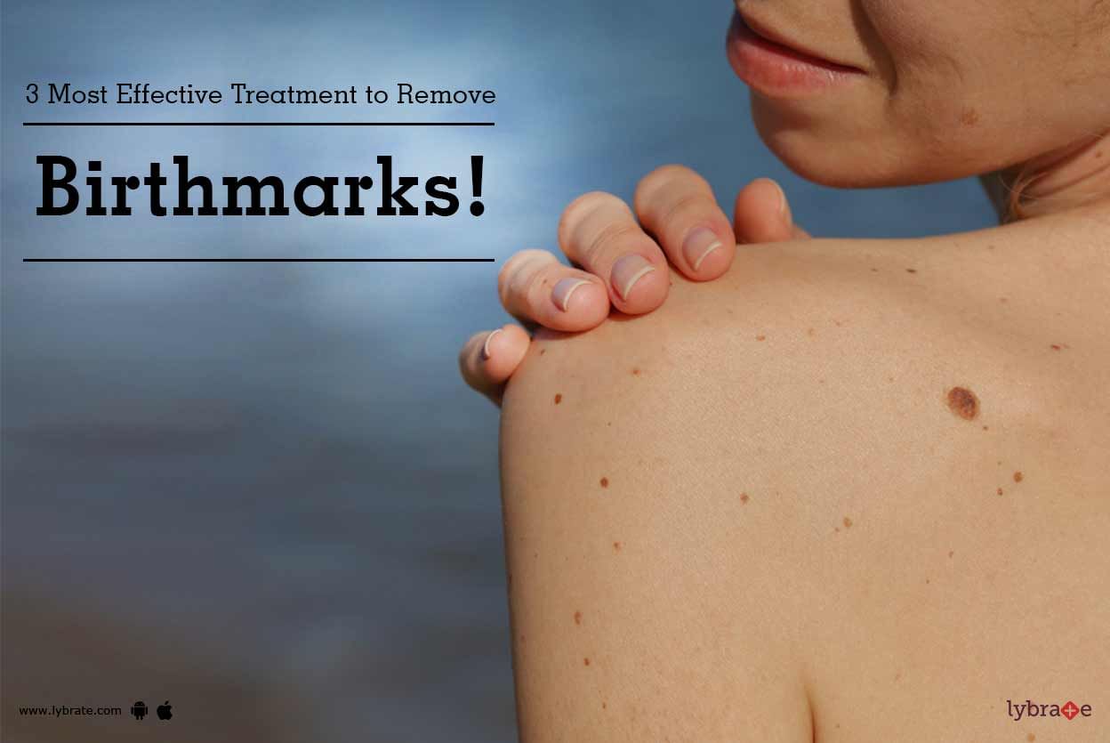 3 Most Effective Treatment to Remove Birthmarks!
