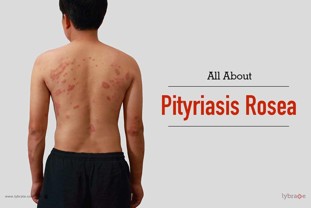 All About Pityriasis Rosea