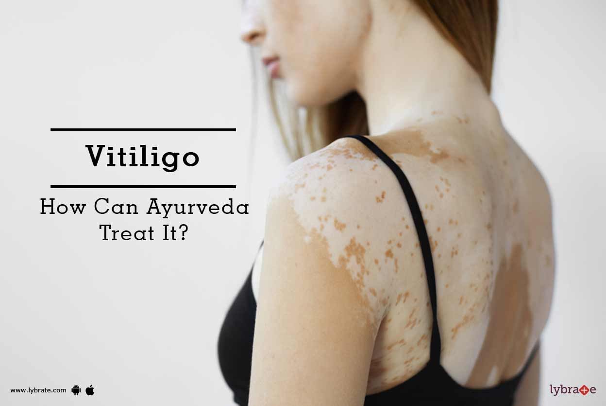 Vitiligo - How Can Ayurveda Treat It?