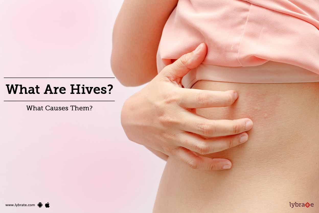 What Are Hives? What Causes Them?