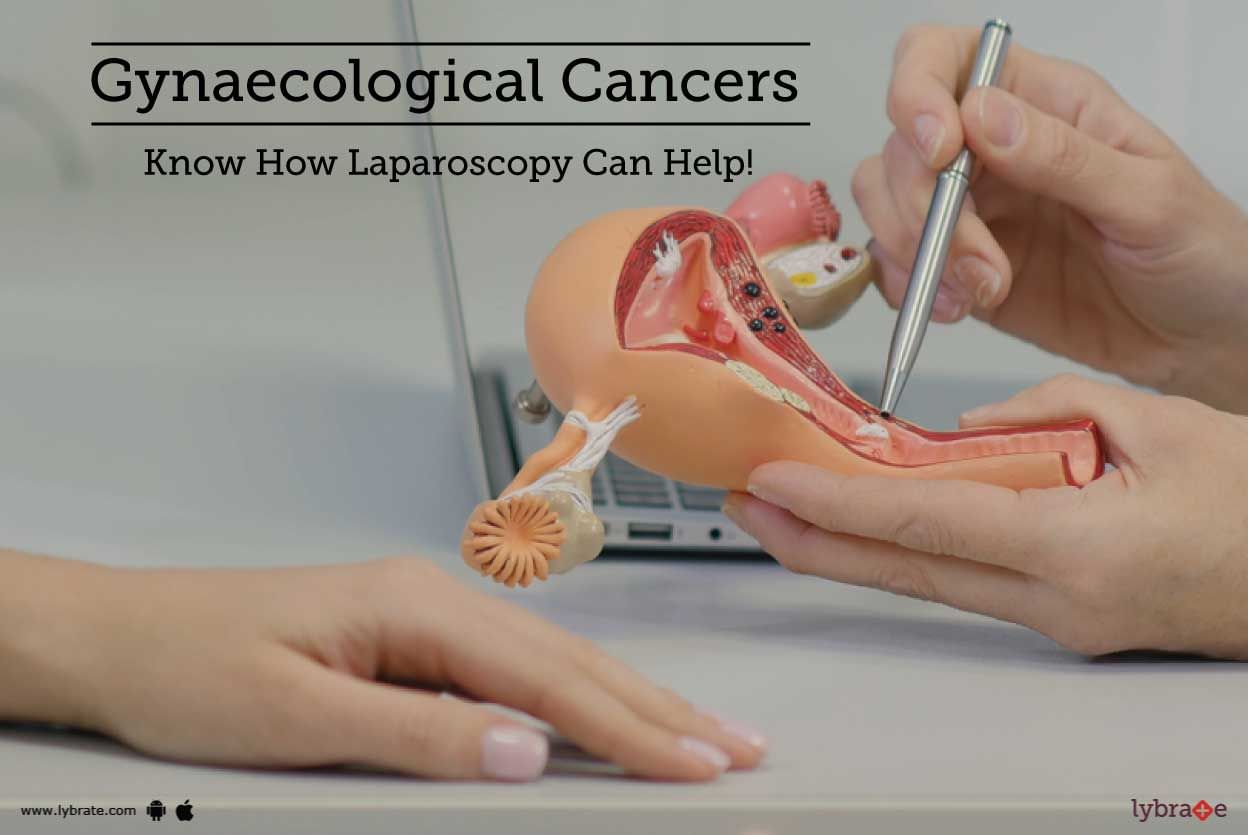 Gynaecological Cancers - Know How Laparoscopy Can Help!