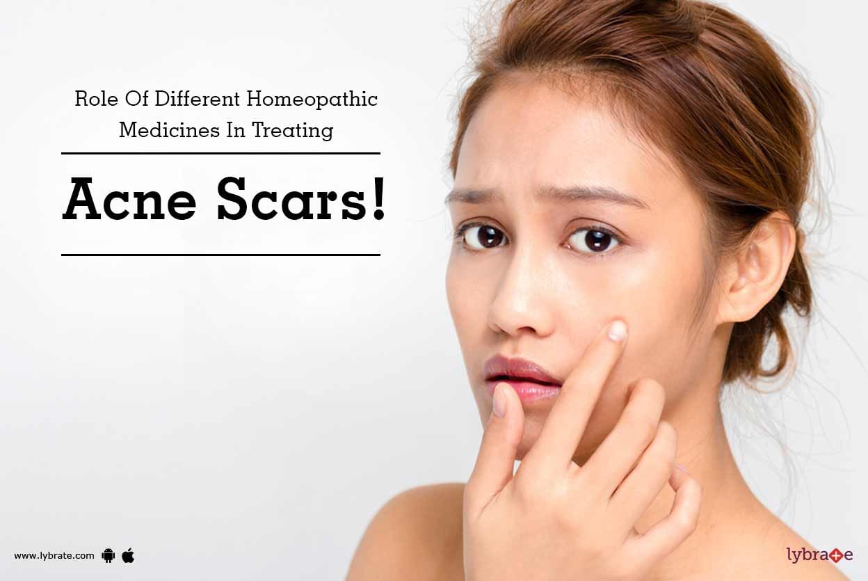 Role Of Different Homeopathic Medicines In Treating Acne Scars!