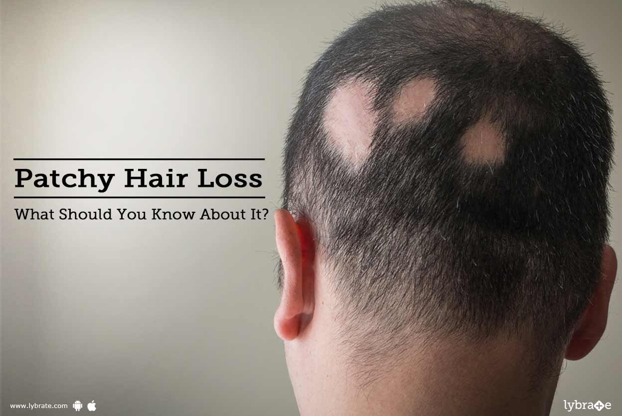 Patchy Hair Loss: What Should You Know About It?