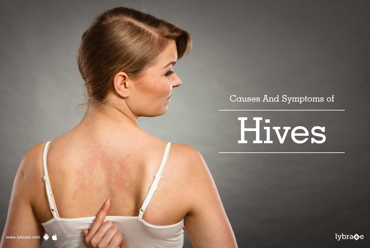 Causes And Symptoms of Hives