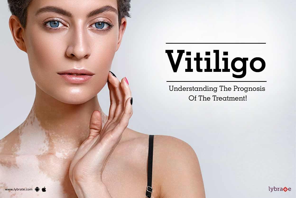 Vitiligo - Understanding The Prognosis Of The Treatment!