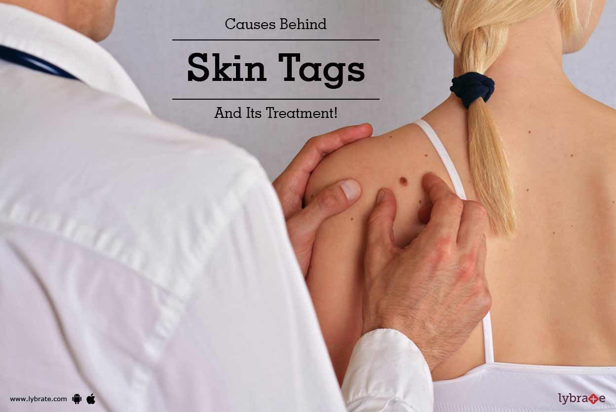 Causes Behind Skin Tags And Its Treatment!