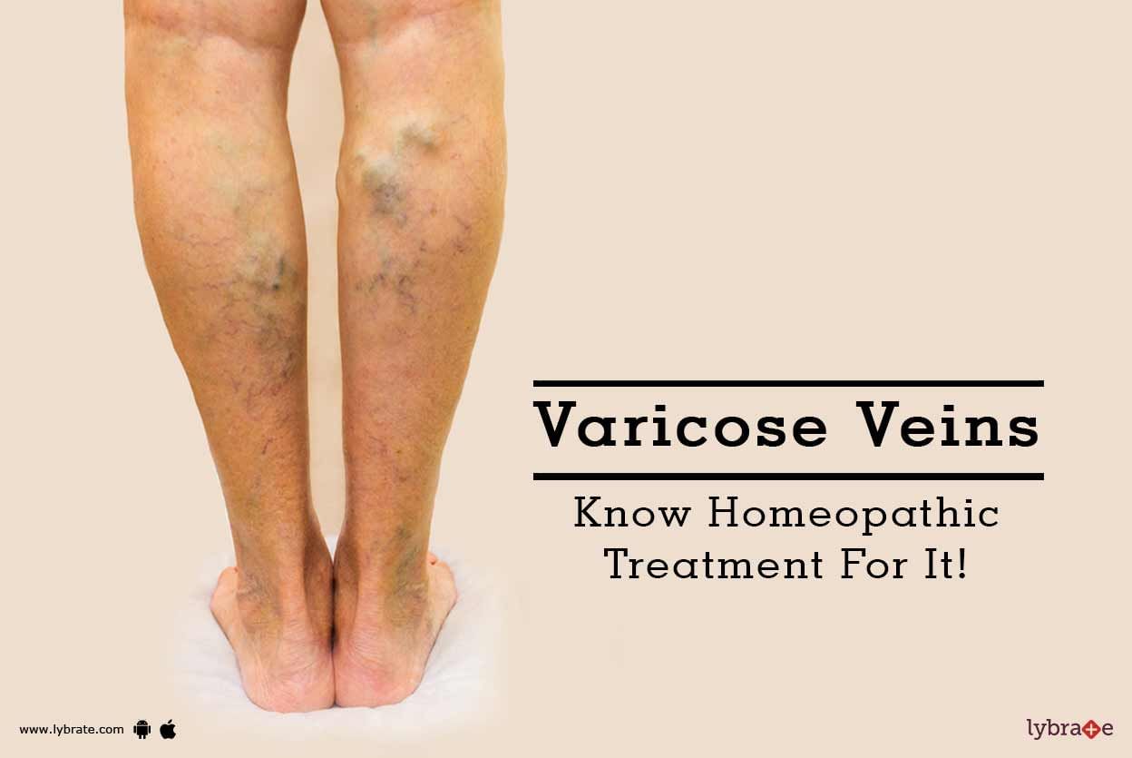 Varicose Veins - Know Homeopathic Treatment For It!