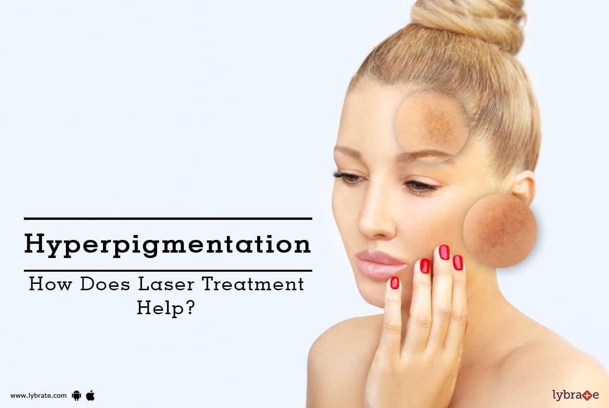 Hyperpigmentation - How Does Laser Treatment Help?