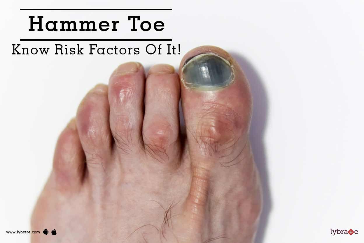 Hammer Toe - Know Risk Factors Of It!