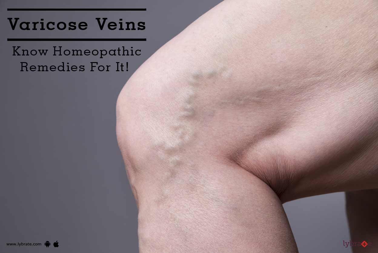 Varicose Veins - Know Homeopathic Remedies For It!