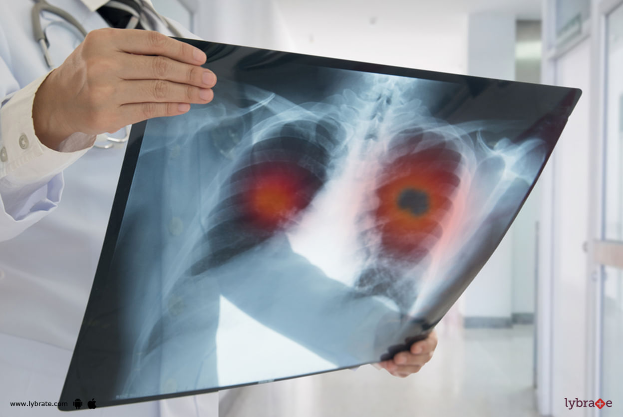 Lung Cancer Screening - What's The Risk Of It?