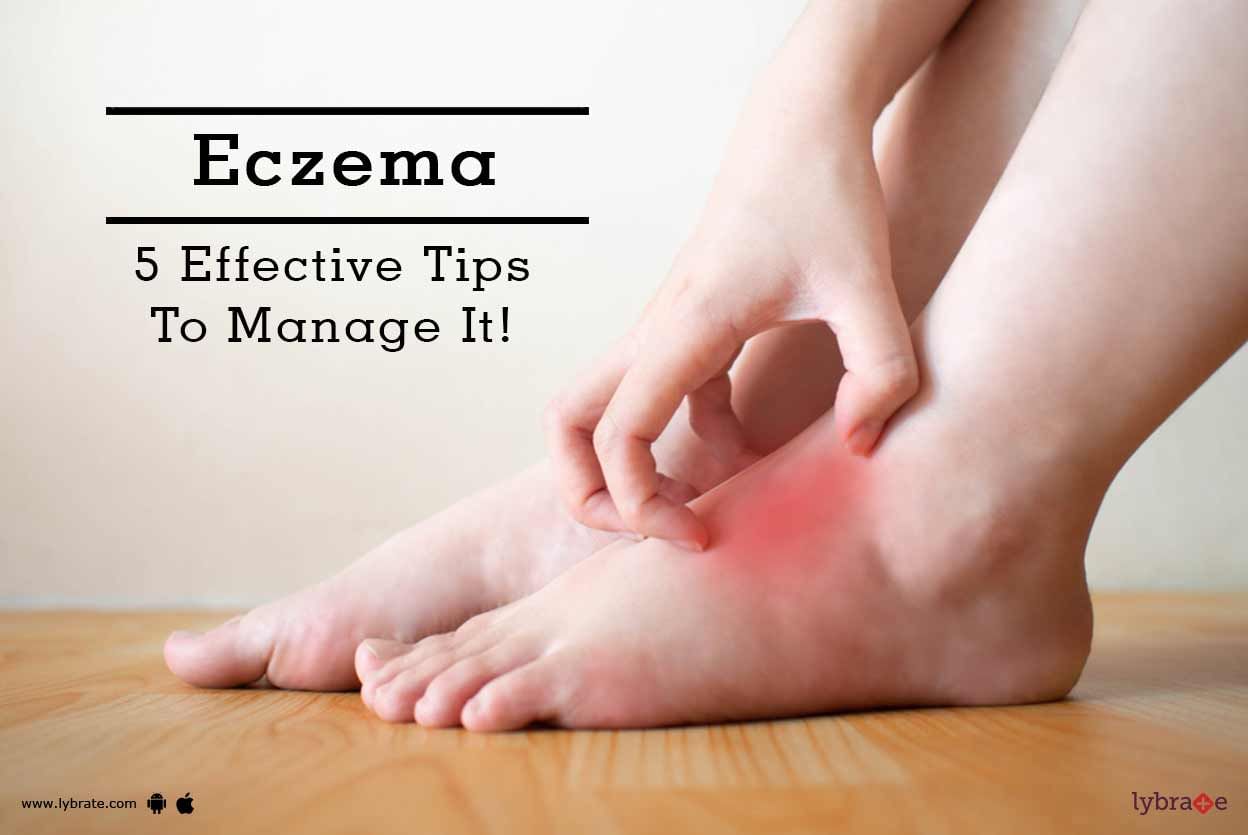 Eczema - 5 Effective Tips To Manage It!