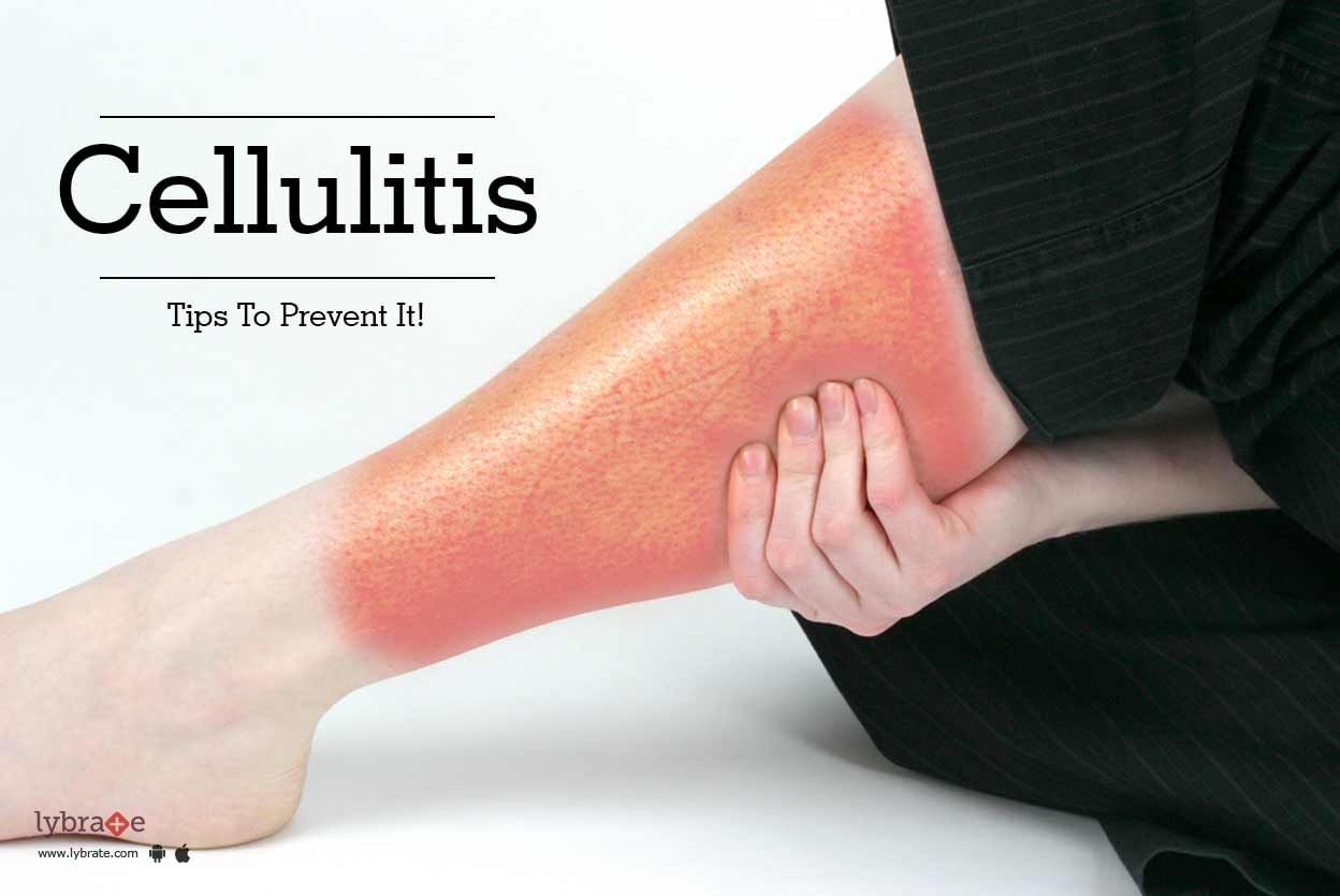 Cellulitis - Tips To Prevent It!