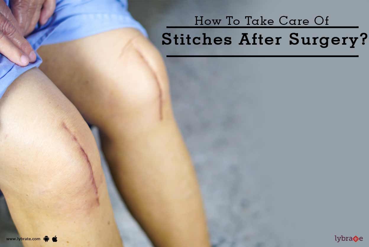 How To Take Care Of Stitches After Surgery?