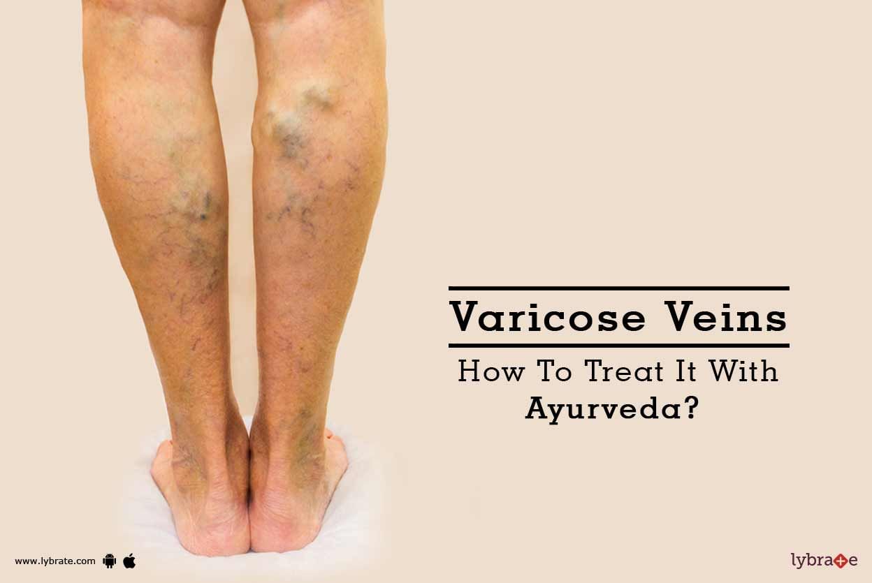 Varicose Veins - How To Treat It With Ayurveda?